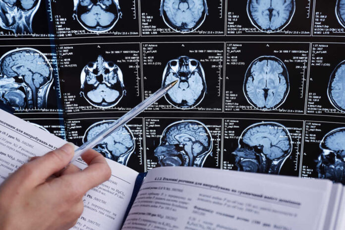 shutterstock_1147345778.jpg featured image Person analyzing brain MRI images with a pen.